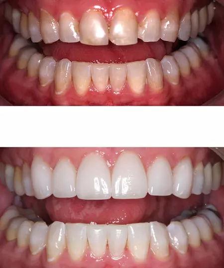 Porcelain Veneers at Dallas Dental Care